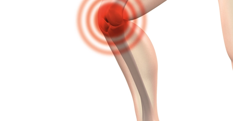 ARTRITIS Y ARTROSIS
