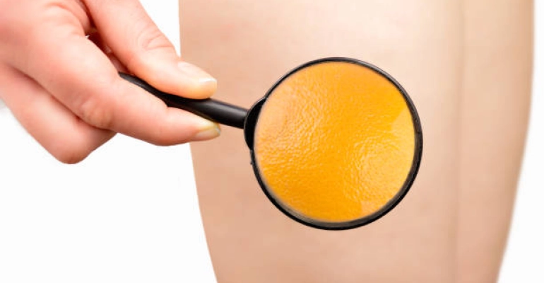 CELULITIS